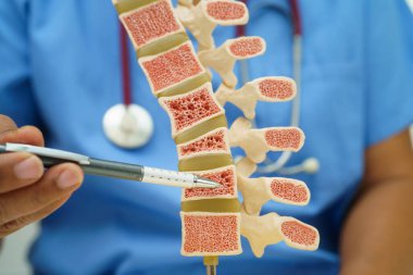Doktor, ortopedi bölümünde tedavi için kemik modelinde osteoporoz tutuyor..