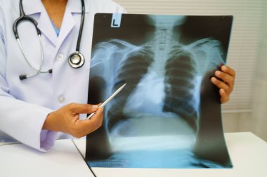 Doktor akciğer röntgen filmini inceliyor..