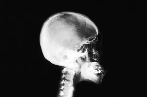 Imagen del aire radiación cráneo y cara . — Foto de Stock