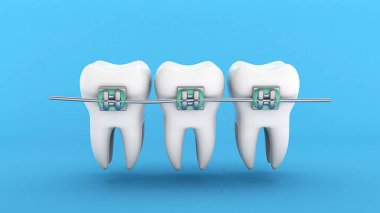 Diş telleri. Diş hizalaması. Mavi arka planda diş teli olan üç beyaz diş. 3d hazırlayıcı
