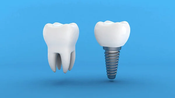 Implante dental. Diente blanco e implante sobre fondo azul. 3d renderizar — Foto de Stock