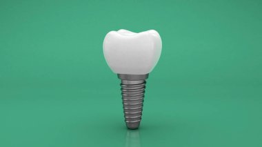 Diş implantı. Takma diş. Yeşil arka plan. 3d hazırlayıcı