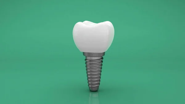 Zubní implantát. Zubař. Zelené pozadí. 3D vykreslení — Stock fotografie