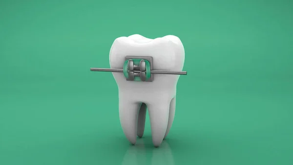 Dentes de metal aparelho. Fundo verde. Renderização 3d — Fotografia de Stock