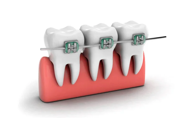 Braçadeiras para os dentes. Alinhamento dos dentes. Dentes na gengiva isolados em um fundo branco. Renderização 3d — Fotografia de Stock