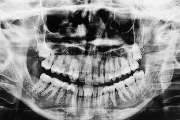 Diversi tipi di problemi di denti del giudizio concetto. Immagine a raggi X dei denti acquisita. Il dente del giudizio si è schiantato contro un molare. Ortopantomografia — Foto Stock