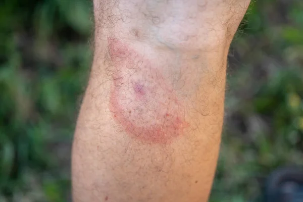 Bir adamın bacağındaki kene ısırığından sonra kızarıklığa yol açıyor. Kene kaynaklı borreliozun bir belirtisi. Bacağında hedef halindeki kırmızı bir yüzük.