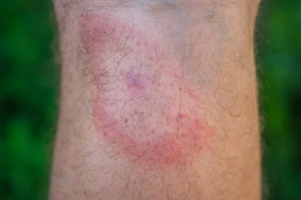 Bir adamın bacağındaki kene ısırığından sonra kızarıklığa yol açıyor. Kene kaynaklı borreliozun bir belirtisi. Bacağında hedef halindeki kırmızı bir yüzük.