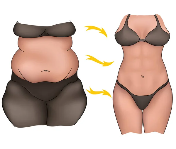 Realistisk Illustration Kvinnlig Kropp Förändras Efter Sport Övningar Kosmetiska Förfaranden — Stock vektor