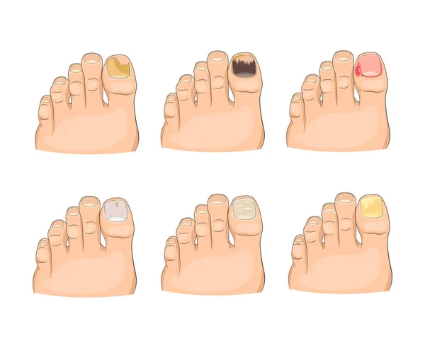 Illustration Maladies Des Ongles Dans Style Dessin Animé Soigné Moderne — Image vectorielle