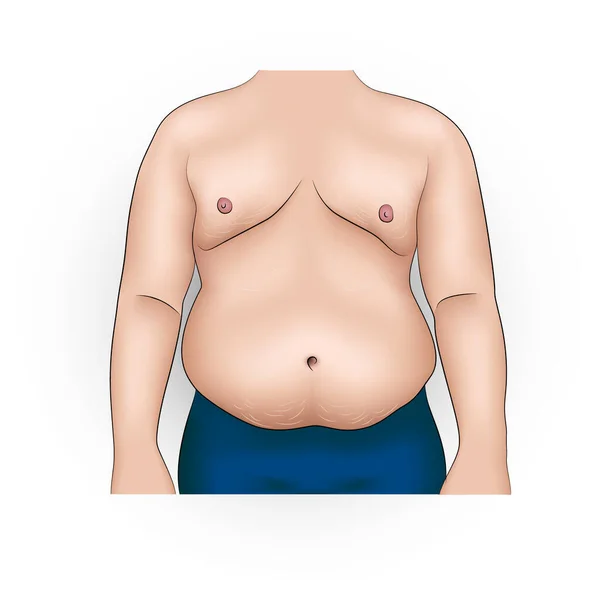 肥満と脂肪の腹を持つ男の現実的なベクトル図 — ストックベクタ