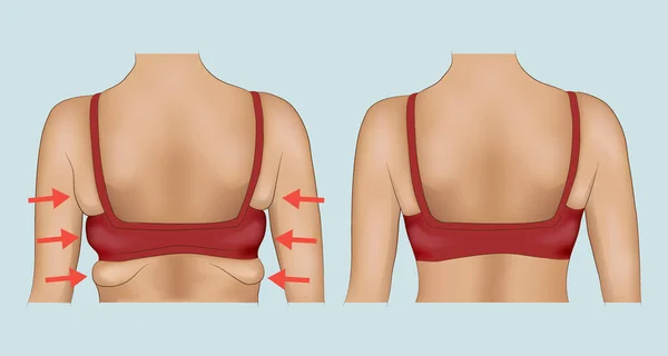 Axilas Gordura Uma Mulher Com Designação Seta Axilas Gordura Antes Vetores De Stock Royalty-Free