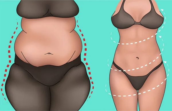 Realistisk Illustration Kvinnlig Kropp Förändras Efter Sport Övningar Kosmetiska Förfaranden — Stock vektor