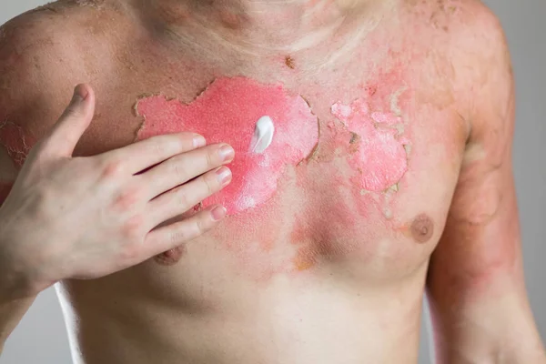 Hand Rubs Burn Cream Man Severe Burn All His Body — Stock Photo, Image