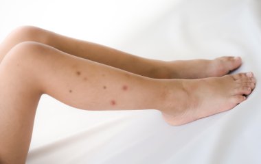 Sivrisinek ısırıkları bebek bacakları üzerinde boğaz