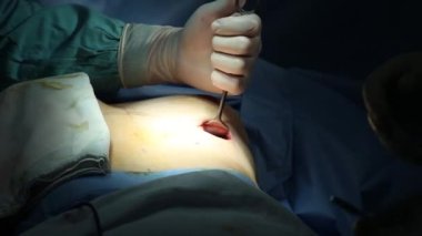 Cerrahlardan oluşan bir ekip göğüs büyütme ameliyatı, meme bakımı, estetik ameliyat konsepti.