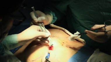 Cerrahlardan oluşan bir ekip göğüs büyütme ameliyatı, meme bakımı, estetik ameliyat konsepti.