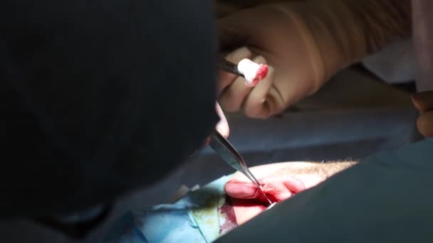 Στραβό Αυτί Πλαστική Χειρουργική Επέμβαση Ωτοπλαστική Αφαίρεση Των Lop Eared — Αρχείο Βίντεο