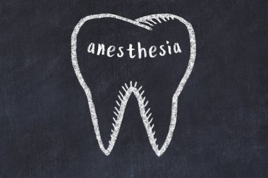 Tıbbi terimle anestezi yapılmış bir dişin tebeşir çizimi. Stomatoloji öğrenme kavramı.