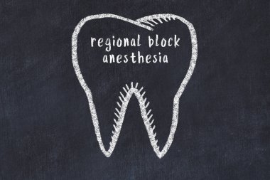 Tıbbi terim olarak bölgesel anestezi içeren tebeşir çizimi. Stomatoloji öğrenme kavramı.