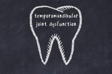Tıbbi terimi temporomandibular eklem bozukluğu olan bir dişin tebeşir çizimi. Stomatoloji öğrenme kavramı.