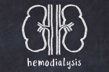 İnsan böbreklerinin tebeşir çizimi ve tıbbi terim hemodiyalizinin. Tıp öğrenme kavramı.