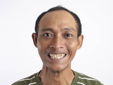 Adamın tartarla dişlerini gösteren yakın plan portresi. Bir sürü tartar ve plaketli dişler. Malocclusion, çarpık dişler. Ortodontiste tedavi, diş teli ve tedaviye ihtiyacı olan sağlıksız dişler kavramı.