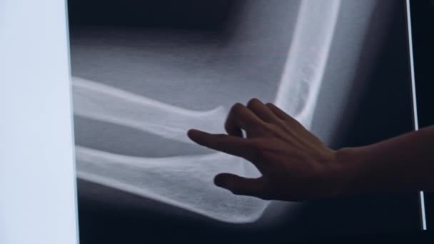 Traumatologo tocca un touch screen con una radiografia dell'osso — Video Stock