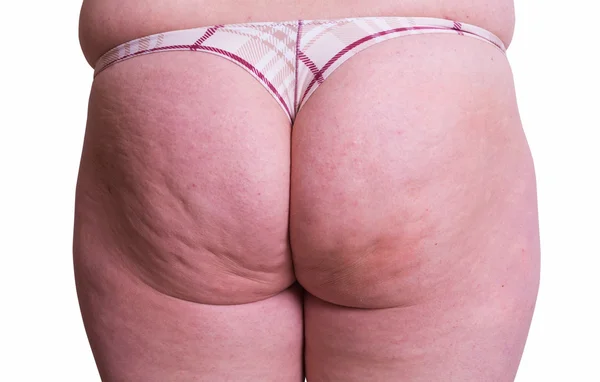 Cellulitisz bőr nő fenék — Stock Fotó
