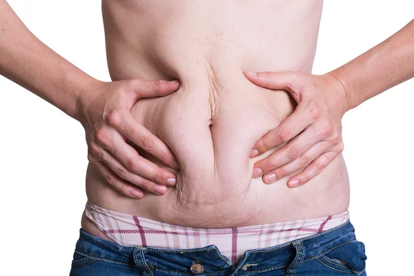 Superficie abdominal de la mujer gorda —  Fotos de Stock