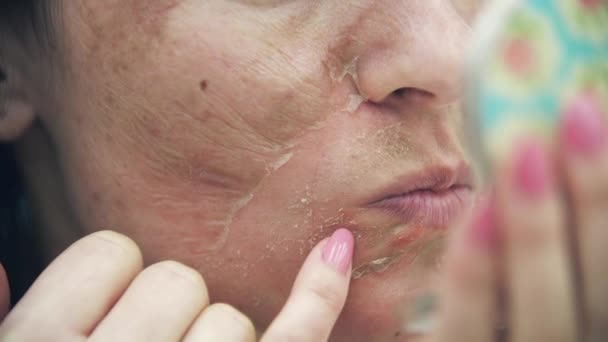 4k крупним планом відео жінки, яка має проблеми зі шкірою, дивлячись у дзеркало . — стокове відео