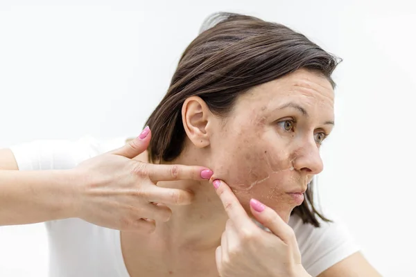 Photo of woman with acne problem squeezing pimple indoors. — Stock Photo, Image