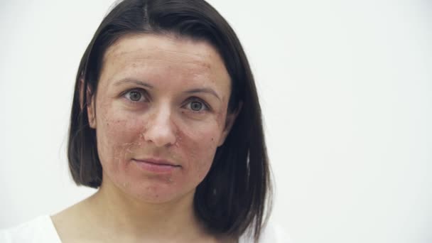 4k close up slow motion vídeo de mulher positiva com pele seca. — Vídeo de Stock