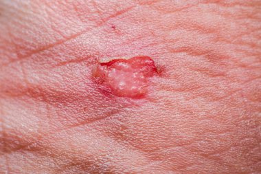 Açık bir yara ile insan derisi kırmızı ham taban ve sıvı dolu vazolar gösteriyor. İyileşme ve iyileşme sürecinde acılı ve iltihaplı bir lezyonun detaylarını gösteriyor.