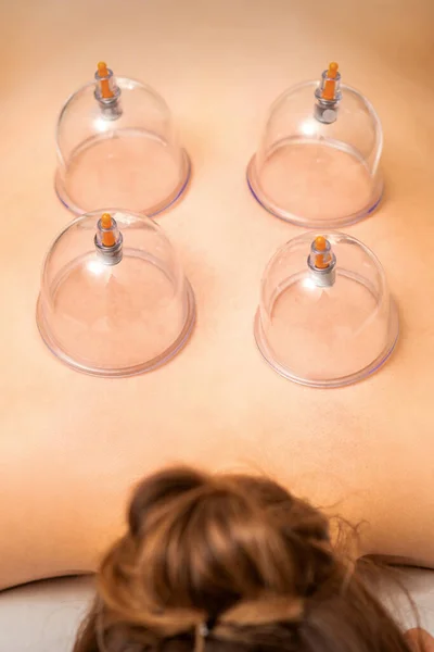 Bicchieri Sottovuoto Terapia Coppettazione Medica Sulla Schiena Della Donna Vicino — Foto Stock