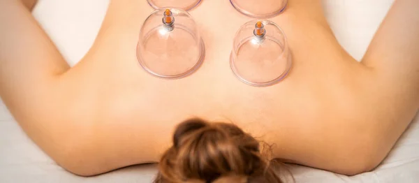 Vakuové Poháry Lékařské Cupping Terapie Ženy Zpět Zblízka Čínské Medicíny — Stock fotografie