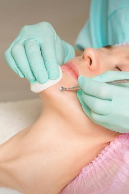 Yüz temizleme. Blackhead Silme Aracı. Güzellik uzmanı güzellik salonunda kadın çenesindeki siyah noktayı ve sivilceyi çıkarıyor.