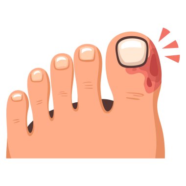 Tırnak iltihabı, ayak enfeksiyonu ayak bileği, onyemikoz ya da parmaklarda mantar gibi eğitici tıbbi kavramların karikatür şişmiş ayak ucu çizimi.