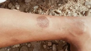 Dış yüzeydeki cilt yanıklarının yakın muayenesi