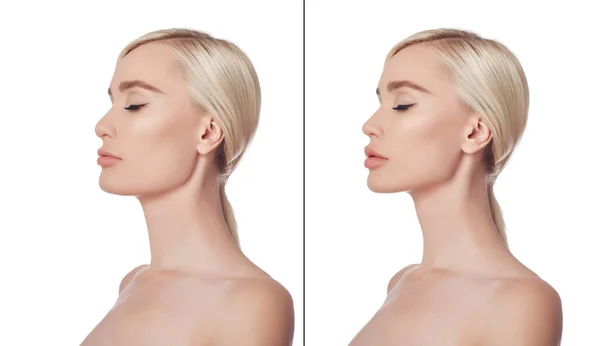 前と後のプラスチック顎手術の女性 化粧品顎の修正 プラスチック手術 減少手術 鼻減少 審美的な薬 整形手術後の美しい若い女性の肖像画 — ストック写真