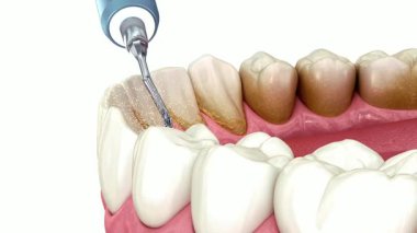 Ultrasonik pulla tartarın alındığını gösteren detaylı diş prosedürü