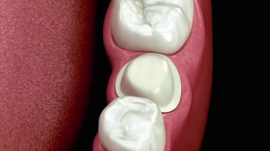 Diş azı dişinde diş eti ve çevresindeki dişler için diş sağlığı ve diş sağlığı için ideal bir taç olduğunu gösteren detaylı bir çizim var.