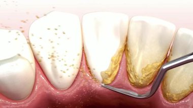 Dişlerin belirgin tartar birikmesi ve sakız hastalığının belirtileri, ağız hijyeninin önemini vurgular.