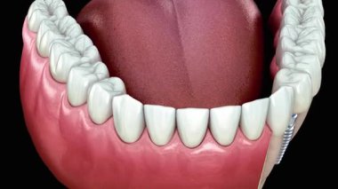 Siyah arka planda beyaz dişler ve pembe diş etleri sergilenen yüksek kaliteli diş modelleri, dişçilikte ve oral sağlıkta eğitim veya profesyonel kullanım için ideal