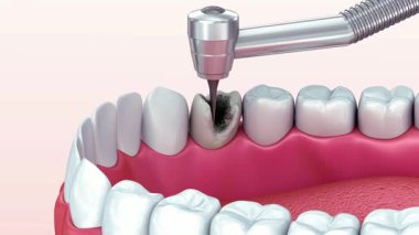 Modern bir diş hekimliği prosedürünü doldurmak, profesyonelliği ve ağız sağlığındaki hassasiyeti iletmek için diş matkabına yakın plan.
