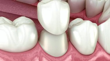 Diş implantı, diş implantı, pembe diş etleri ve siyah arka planda parlak beyaz dişler, dişçilik ve ağız sağlığı kavramları için idealdir.