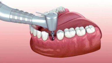 Diş sunumları veya eğitim amacıyla gerçekçi diş ve diş etlerini gösteren son derece detaylı takma diş modeli.