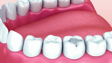 Diş sağlığı eğitimi için sağlıklı ve çürük dişleri gösteren detaylı diş örnekleri