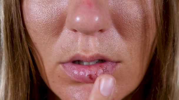 Herpes simplex virusinfectie treft vrouwen lip — Stockvideo