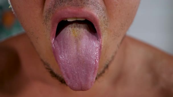 Vuxen man öppnar munnen och visar tungan med vit beläggning — Stockvideo